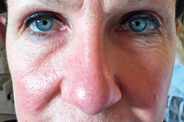 Before-Anti Aging