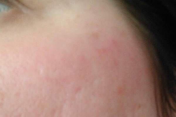 After-Rosacea