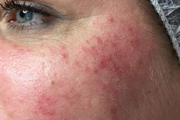 Before-Rosacea